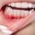 Diş Eti Hastalıkları