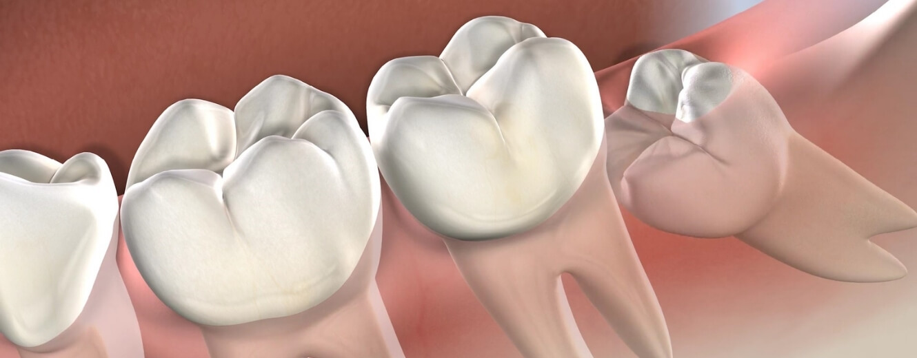 Gaziosmanpaşa’da Ağrısız Yirmilik Diş Çekimi Gaziosmanpaşa’da Ağrısız Yirmilik Diş Çekimi