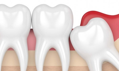 Beşyüzevler'de 20’lik Diş Çekimi