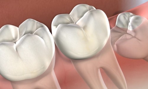 Gaziosmanpaşa’da Ağrısız Yirmilik Diş Çekimi