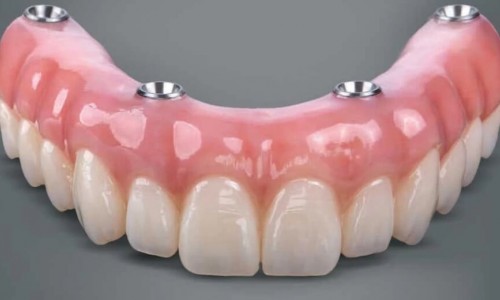 All On Four İmplant İstanbul