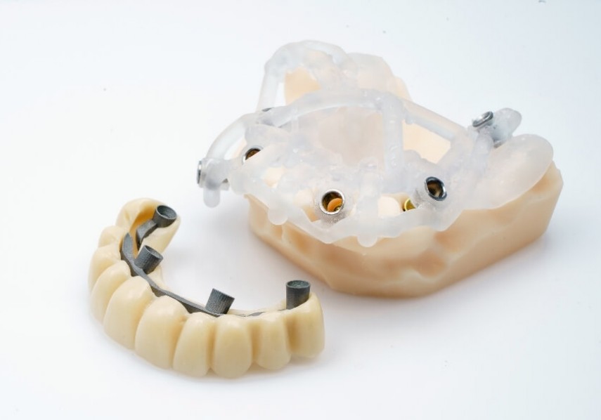 implant tedavisi