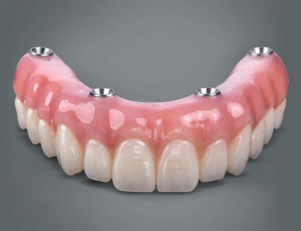 implant tedavisi