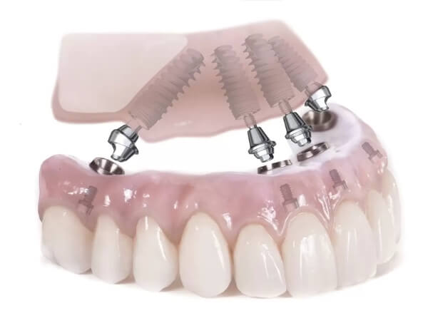 implant tedavisi