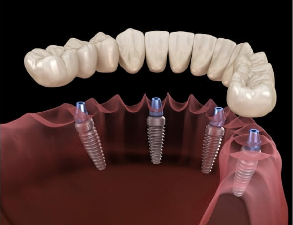 implant tedavisi