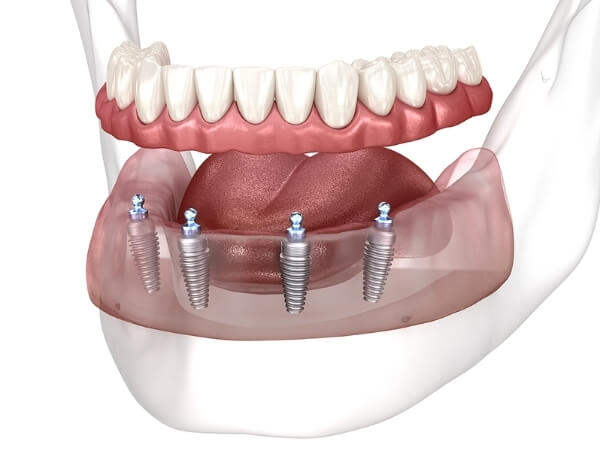 implant tedavisi