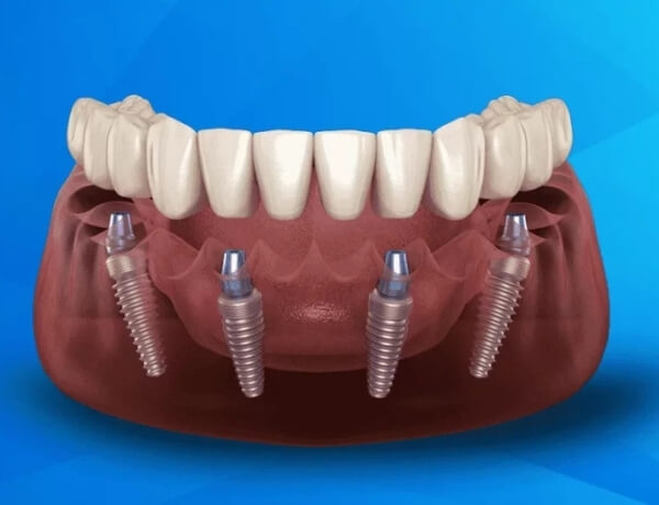 implant tedavisi