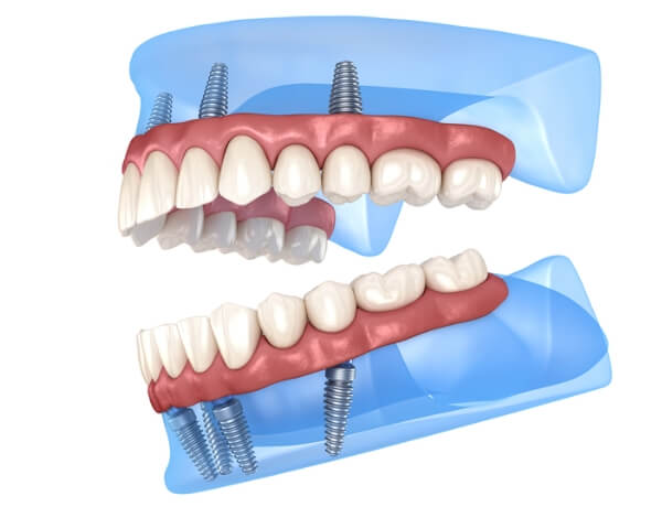 implant tedavisi