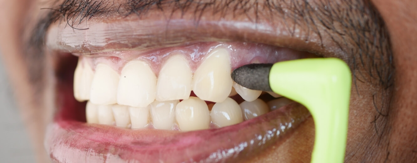 Gaziosmanpaşa Diş Beyazlatma Gaziosmanpaşa Diş Beyazlatma