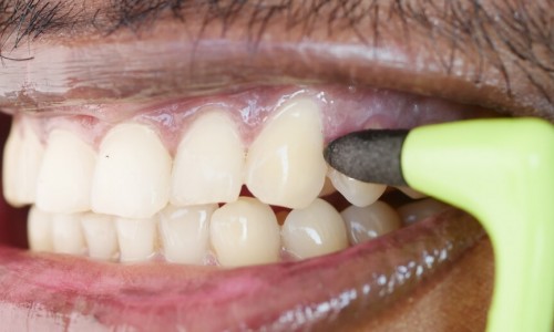 Gaziosmanpaşa Diş Beyazlatma