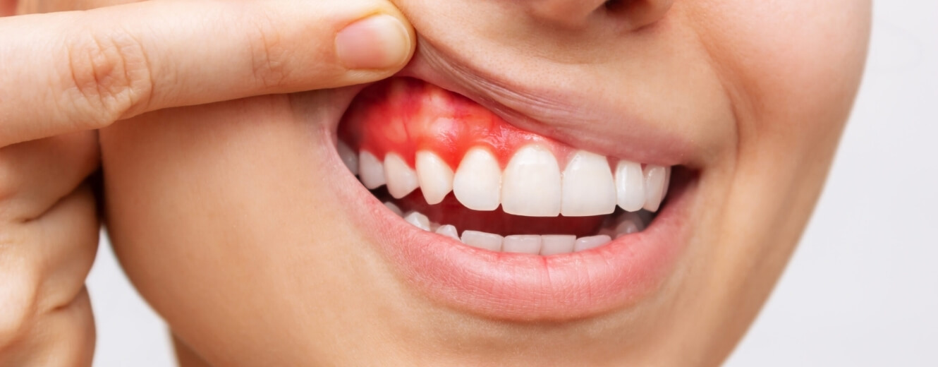 Diş Eti Hastalıkları Nasıl Önlenir ve Tedavi Edilir?