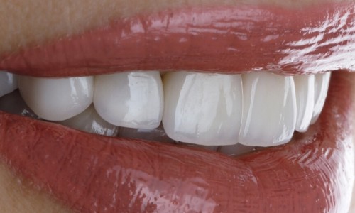 Gaziosmanpaşa Gülüş Tasarımı