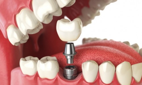 Bayrampaşa Dikişsiz İmplant Tedavisi Mümkün mü?