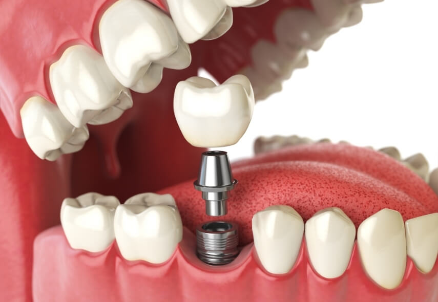 implant tedavisi