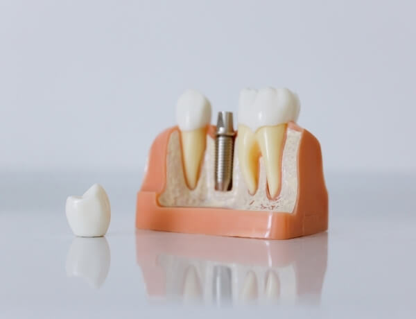 implant tedavisi