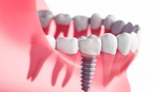 İmplant Tedavisinde Hangi Malzemeler Kullanılır?