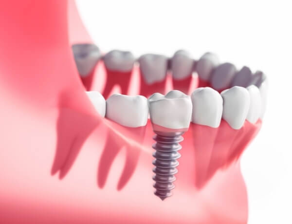 implant tedavisi