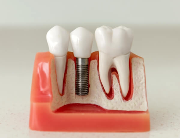 implant tedavisi
