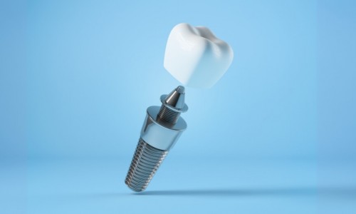 İmplant Sonrası Nelere Dikkat Edilmelidir?