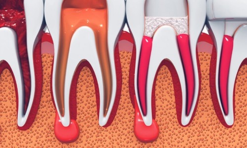 Kanal Tedavisi Ne Zaman Gereklidir?