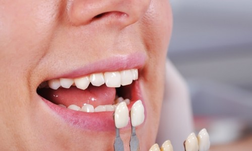 Beşyüzevler’de Porselen Diş Kaplama Ne Kadar Dayanıklıdır?