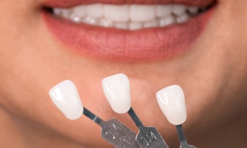 Kaplama Dişlerde Renk Değişimi Olur mu?