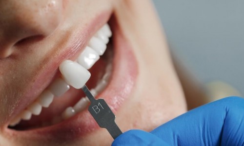 Zirkonyum Kaplama Diş Eti Problemlerine Sebep Olur mu?